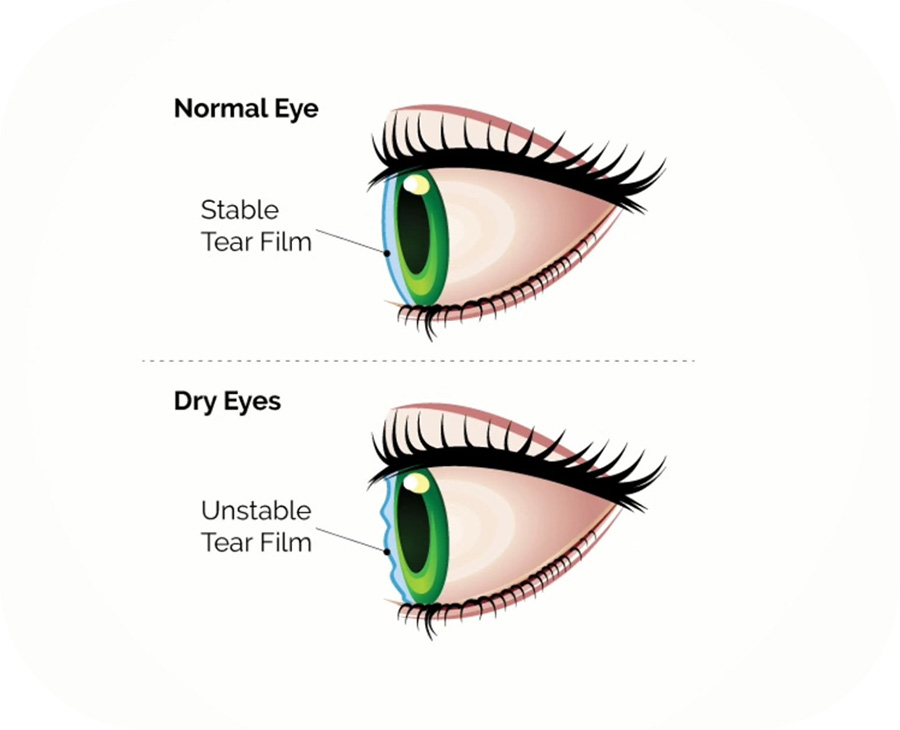 Specialised care for dry, irritated and uncomfortable eyes